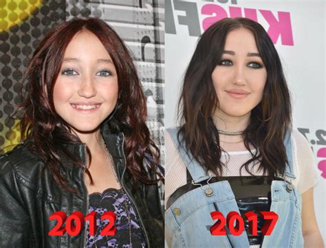 noah cyrus nose job|Noah Cyruss plastic surgery